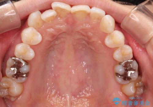 八重歯と前歯のガタガタをインビザラインでの治療前