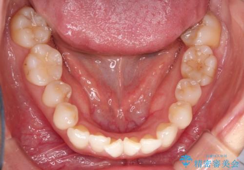 八重歯と前歯のガタガタをインビザラインでの治療前