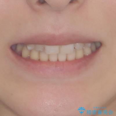 補助装置を併用したインビザラインでの八重歯の抜歯矯正の治療後（顔貌）