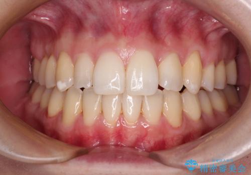 補助装置を併用したインビザラインでの八重歯の抜歯矯正の症例 治療後