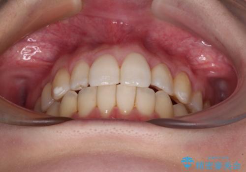 補助装置を併用したインビザラインでの八重歯の抜歯矯正の治療後