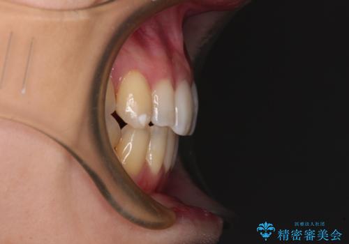 補助装置を併用したインビザラインでの八重歯の抜歯矯正の治療後