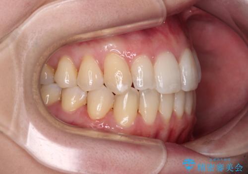 補助装置を併用したインビザラインでの八重歯の抜歯矯正の治療後