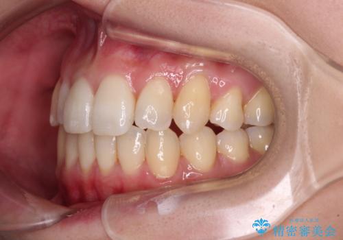 補助装置を併用したインビザラインでの八重歯の抜歯矯正の治療後