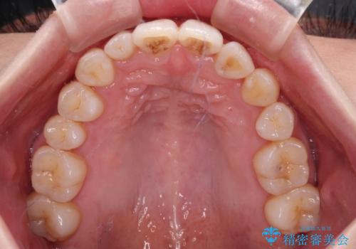 補助装置を併用したインビザラインでの八重歯の抜歯矯正の治療後