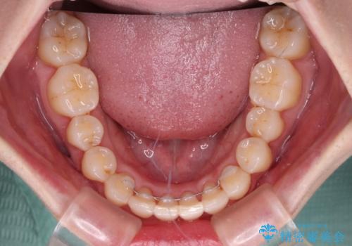 補助装置を併用したインビザラインでの八重歯の抜歯矯正の治療後