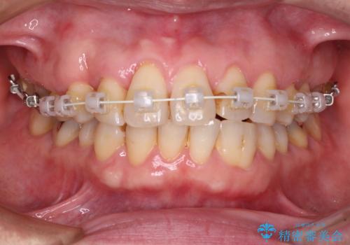 八重歯と形の悪い前歯　矯正治療とセラミック治療の治療中