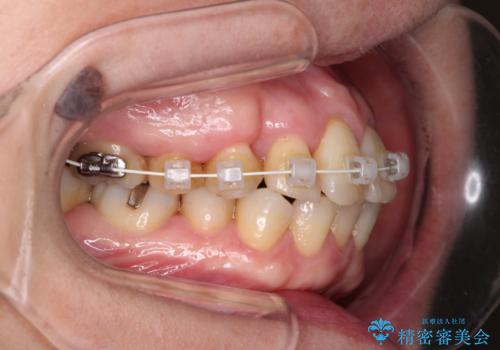 八重歯と形の悪い前歯 矯正治療とセラミック治療の治療中