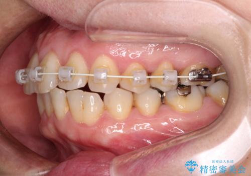 八重歯と形の悪い前歯 矯正治療とセラミック治療の治療中