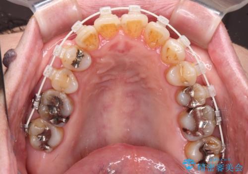 八重歯と形の悪い前歯 矯正治療とセラミック治療の治療中