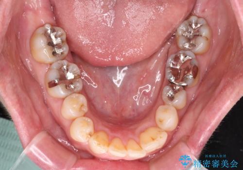 八重歯と形の悪い前歯 矯正治療とセラミック治療の治療中