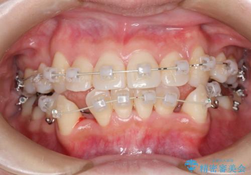 コンプレックスだった前歯のガタガタがここまで綺麗になるなんて!!の治療中