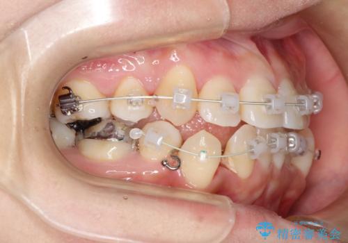 コンプレックスだった前歯のガタガタがここまで綺麗になるなんて!!の治療中