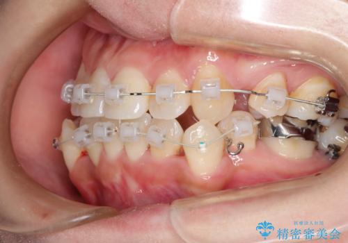 コンプレックスだった前歯のガタガタがここまで綺麗になるなんて!!の治療中