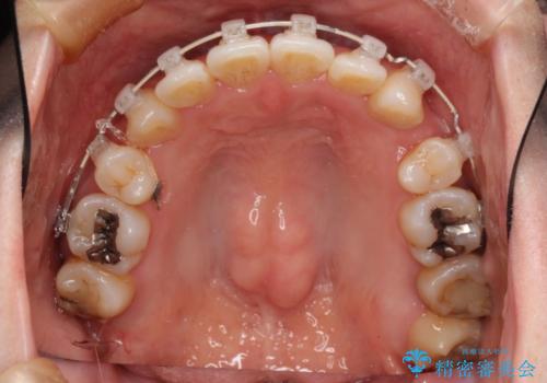 コンプレックスだった前歯のガタガタがここまで綺麗になるなんて!!の治療中