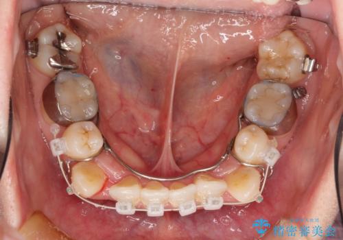 コンプレックスだった前歯のガタガタがここまで綺麗になるなんて!!の治療中