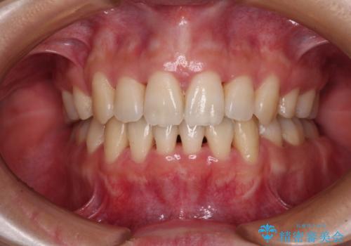 Eラインを改善したい ハーフリンガルによる抜歯矯正の症例 治療後