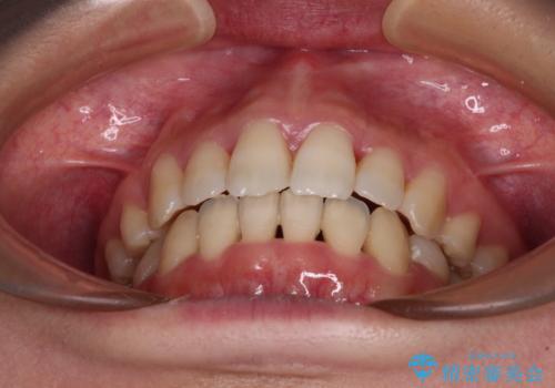 Eラインを改善したい ハーフリンガルによる抜歯矯正の治療後