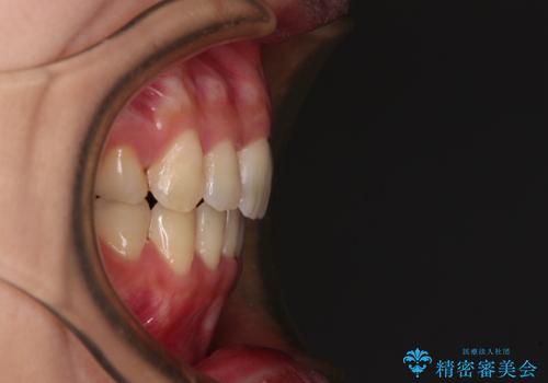 Eラインを改善したい ハーフリンガルによる抜歯矯正の治療後