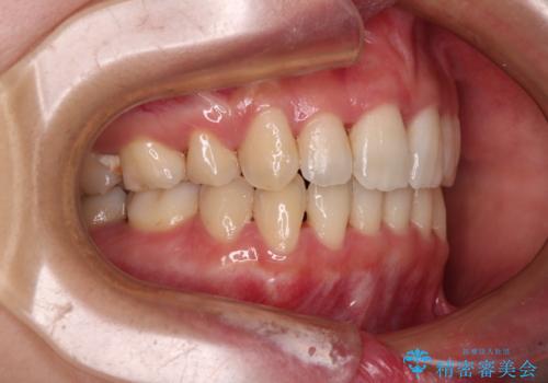 Eラインを改善したい ハーフリンガルによる抜歯矯正の治療後