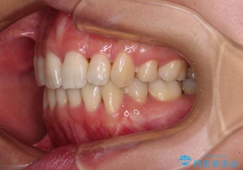 Eラインを改善したい ハーフリンガルによる抜歯矯正の治療後