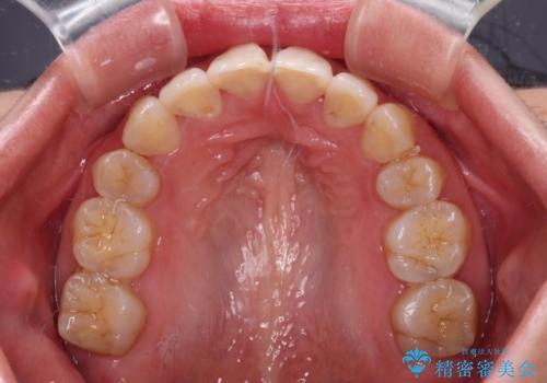 Eラインを改善したい ハーフリンガルによる抜歯矯正の治療後