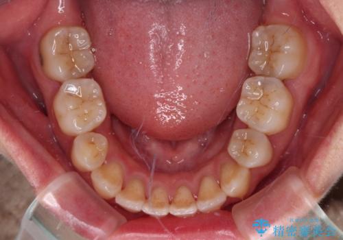 Eラインを改善したい ハーフリンガルによる抜歯矯正の治療後