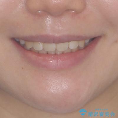 出っ歯を改善　目立たないワイヤー装置での抜歯矯正の治療後（顔貌）