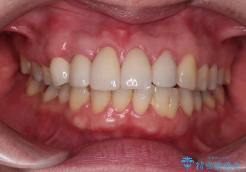 八重歯と形の悪い前歯　矯正治療とセラミック治療の症例 治療後