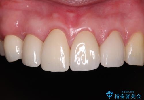 八重歯と形の悪い前歯 矯正治療とセラミック治療の治療後