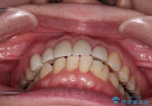 八重歯と形の悪い前歯 矯正治療とセラミック治療の治療後