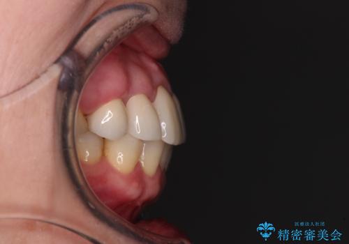 八重歯と形の悪い前歯　矯正治療とセラミック治療の治療後