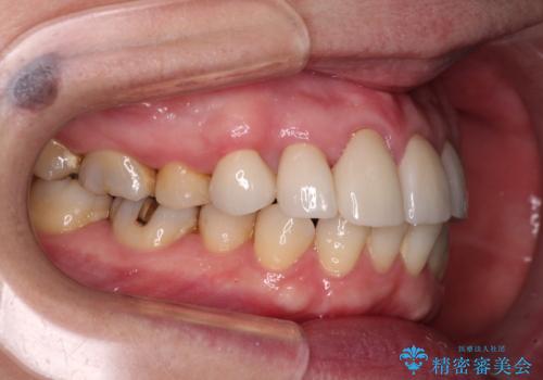 八重歯と形の悪い前歯 矯正治療とセラミック治療の治療後