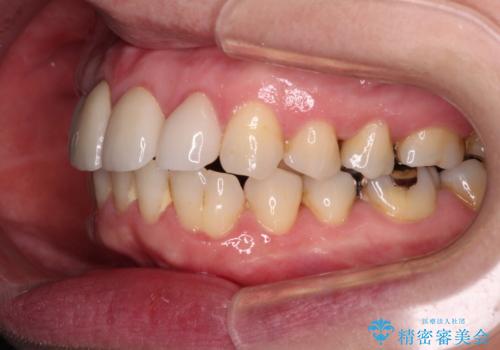 八重歯と形の悪い前歯 矯正治療とセラミック治療の治療後