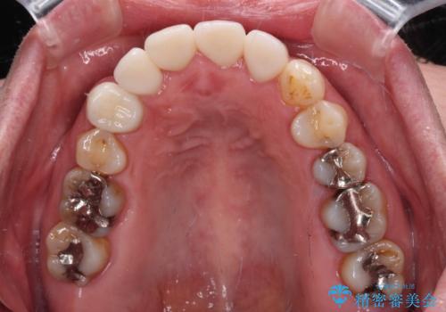 八重歯と形の悪い前歯 矯正治療とセラミック治療の治療後