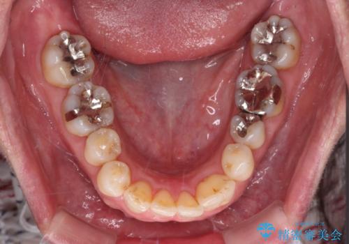 八重歯と形の悪い前歯 矯正治療とセラミック治療の治療後