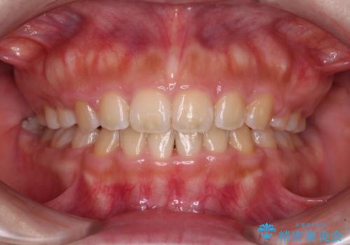 口元を引っ込めたい 目立たないワイヤー装置での抜歯矯正の症例 治療後