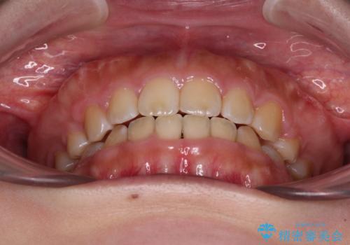 口元を引っ込めたい 目立たないワイヤー装置での抜歯矯正の治療後