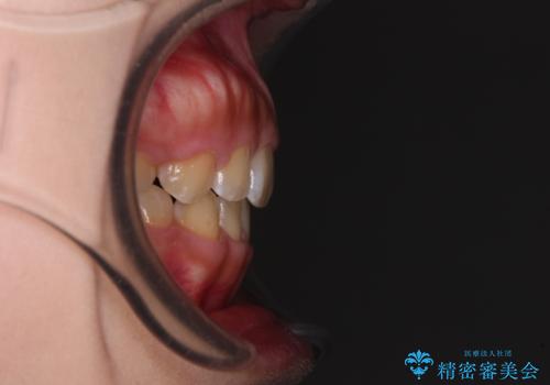 口元を引っ込めたい　目立たないワイヤー装置での抜歯矯正の治療後