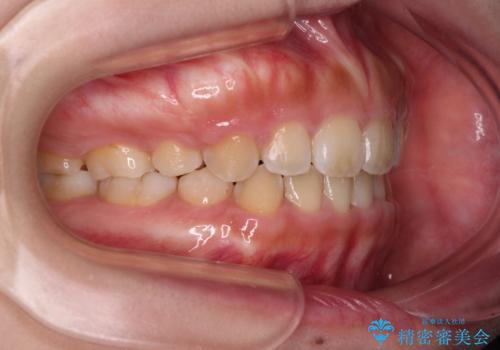 口元を引っ込めたい 目立たないワイヤー装置での抜歯矯正の治療後
