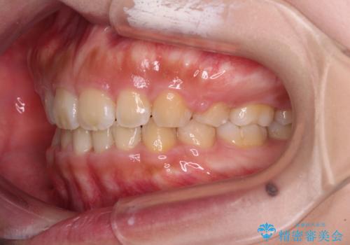 口元を引っ込めたい 目立たないワイヤー装置での抜歯矯正の治療後