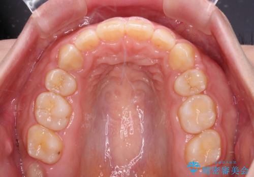 口元を引っ込めたい 目立たないワイヤー装置での抜歯矯正の治療後