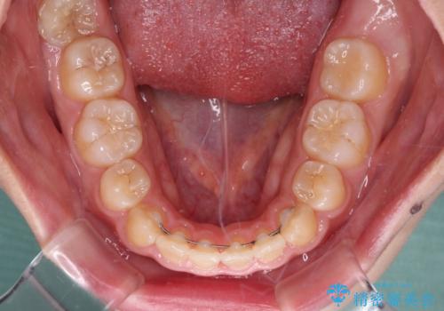 口元を引っ込めたい 目立たないワイヤー装置での抜歯矯正の治療後