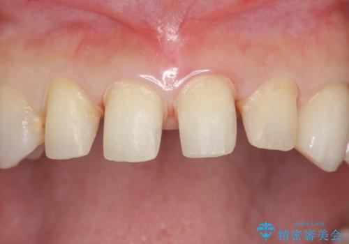 つぎはぎの前歯をセラミックにしたいの治療中