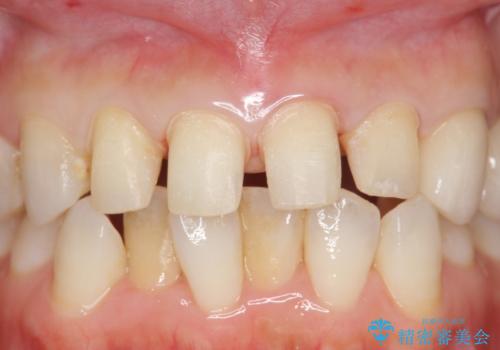 つぎはぎの前歯をセラミックにしたいの治療中