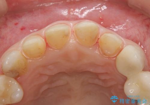 つぎはぎの前歯をセラミックにしたいの治療中