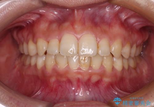 前歯のクロスバイト　目立たないワイヤー装置で速やかに矯正治療