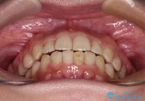前歯のクロスバイト　目立たないワイヤー装置で速やかに矯正治療の治療後