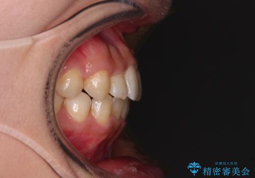 前歯のクロスバイト 目立たないワイヤー装置で速やかに矯正治療の治療後
