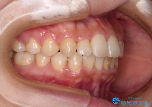 前歯のクロスバイト 目立たないワイヤー装置で速やかに矯正治療の治療後